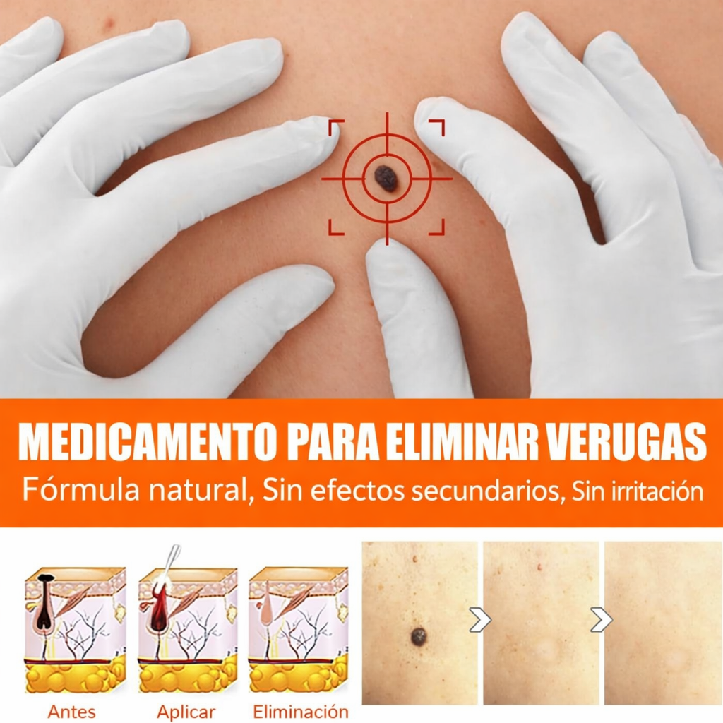 DermaClear - ¡Ayuda a reducir verrugas visibles!