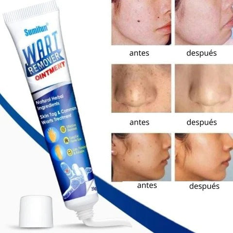 VerruSkin 💉👃 ¡Ayuda a reducir verrugas y acrocordones desde casa!