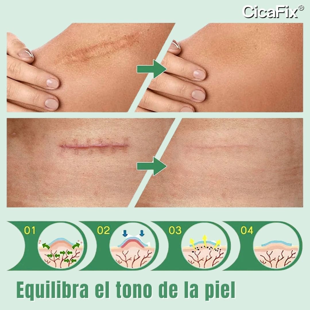 CicaFix 2 X 1 – Rollos Parches Silicon Quita Cicatrices