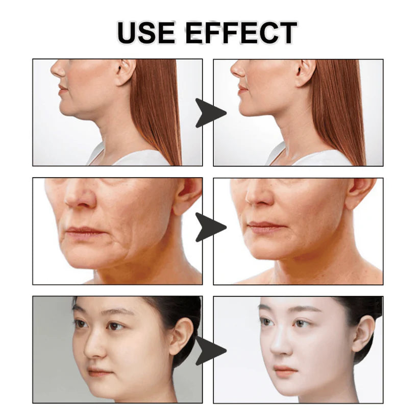 VLine Lift 3X1 - ¡Efecto lifting facial discreto!